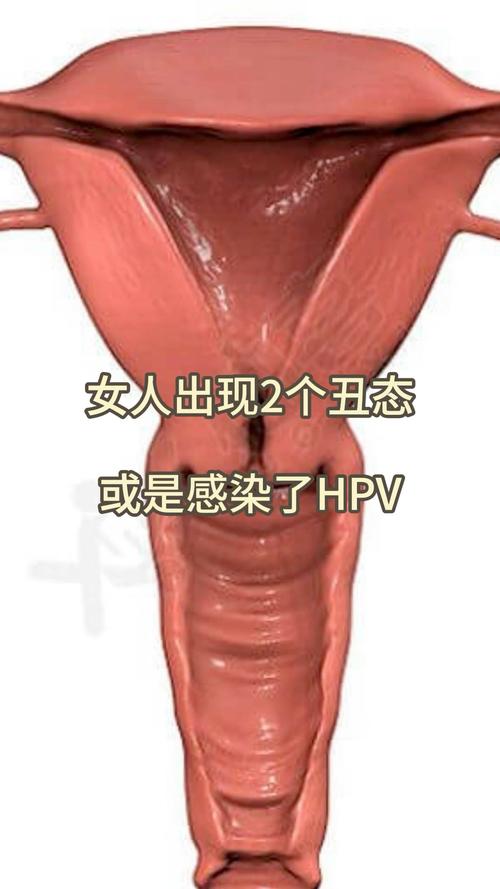 两个女人一个男人会传染HPV吗更新了，平台：健康知识网